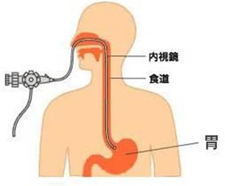 胃痛就一定要做胃鏡檢查嗎？哪些人需要做胃鏡？多久檢查一次好？ 未分類 第1張