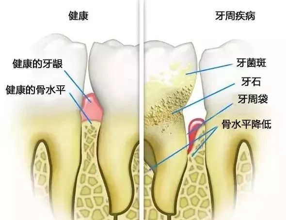 成人口臭_早晨起床后有3件 长寿事 你能坚持做吗(3)