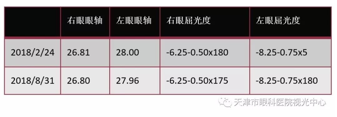 该顾客配戴半年无论屈光度还是眼轴长度均未增长,近视进展得到有效