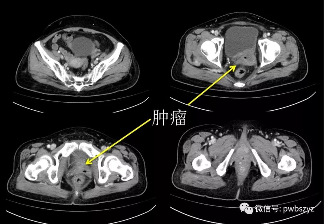 手术前3个月盆腔ct相关影像学资料:复查ct及mri肿瘤局部进展明显,未