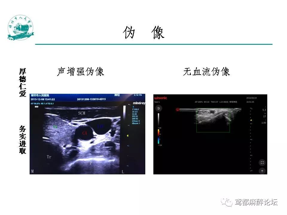 实用 如何做好超声引导神经阻滞_麻醉