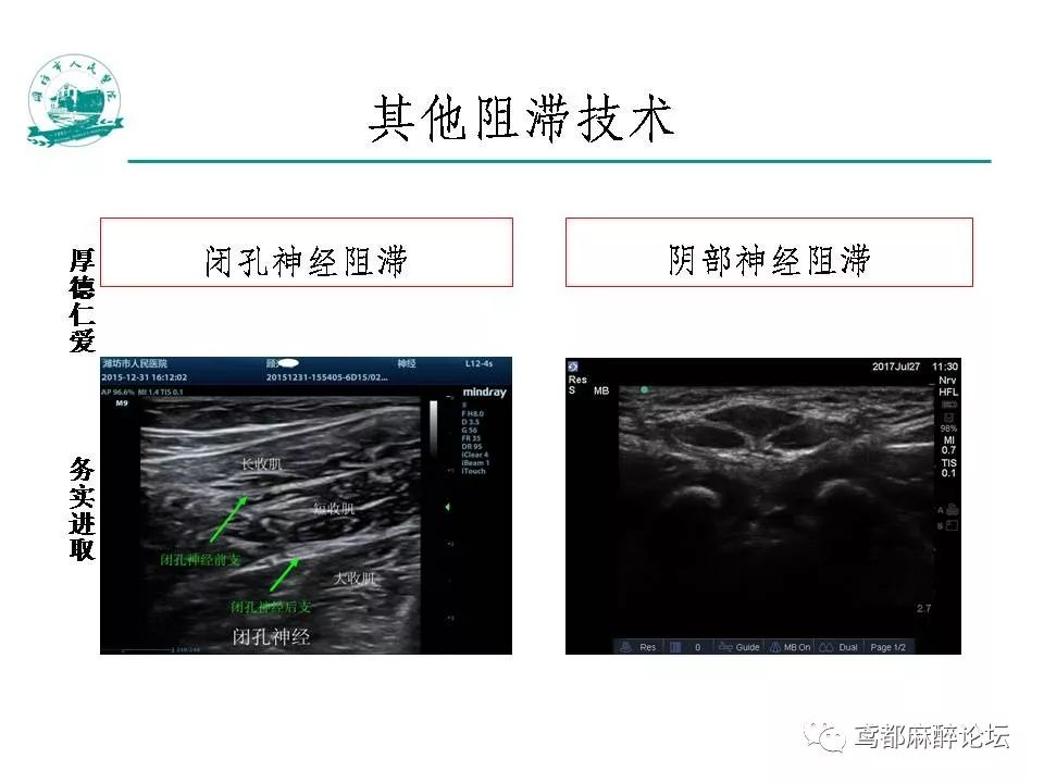 实用 如何做好超声引导神经阻滞_麻醉