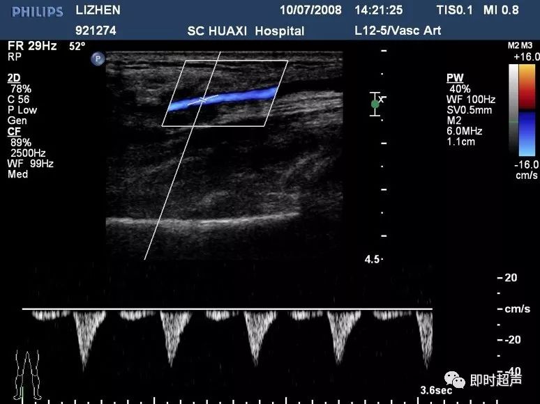 下肢血管超声检查及诊断思路(下)