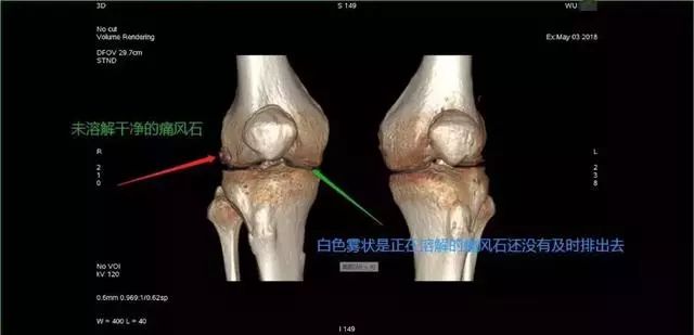 动脉硬化检测的原理是什么_动脉硬化检测(3)