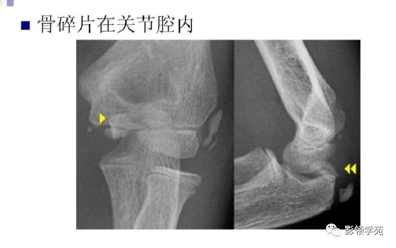 儿童肘关节骨折x线诊断