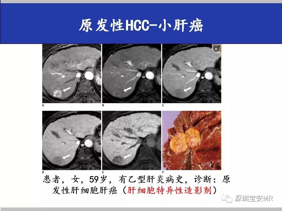 征文作品原发性肝细胞肝癌hcc的mr诊断及鉴别诊断