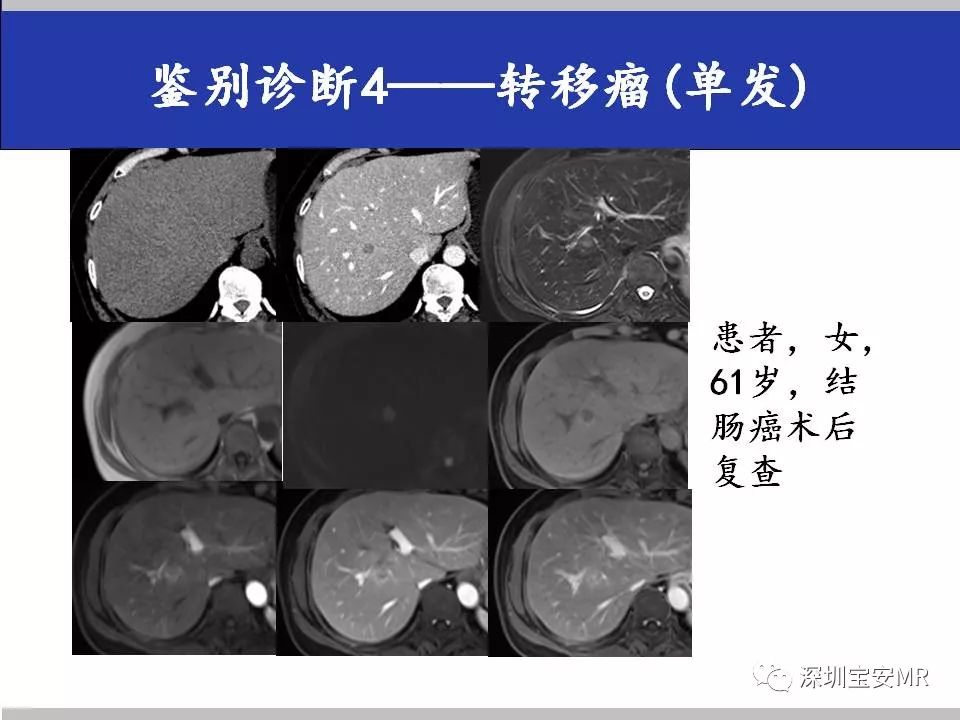 征文作品原发性肝细胞肝癌hcc的mr诊断及鉴别诊断