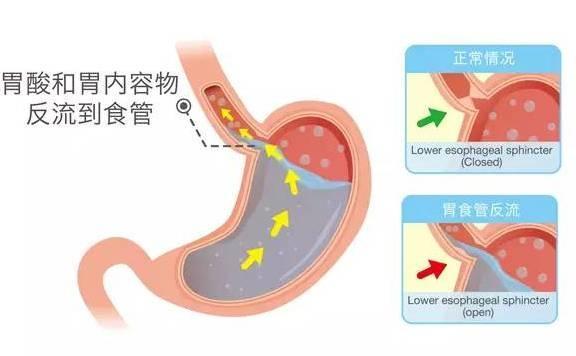 反酸、燒心、嗓子有異物怎麼回事？可能是這種「病」導致，要當心 健康 第2張