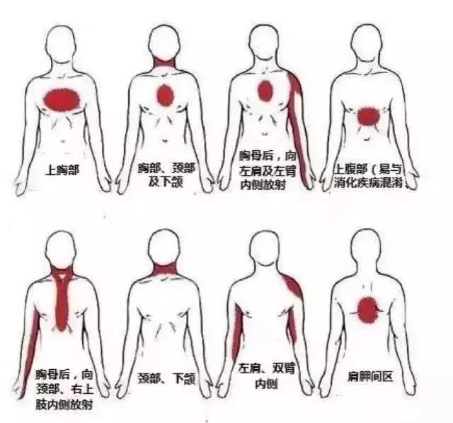 如何辨别心绞痛?这3个方法一定要掌握_胸口