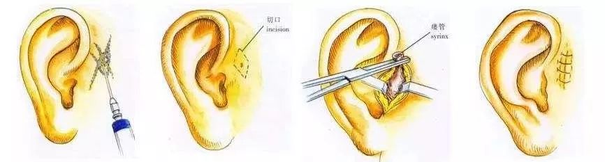 差一点做手术,孩子耳朵上的小孔千万小心_耳仓