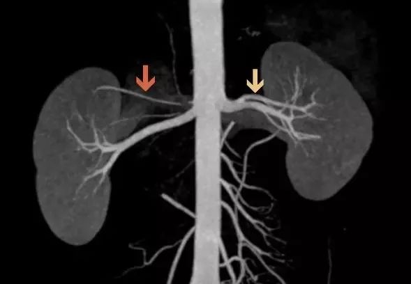 图文详解:肾动脉变异特点