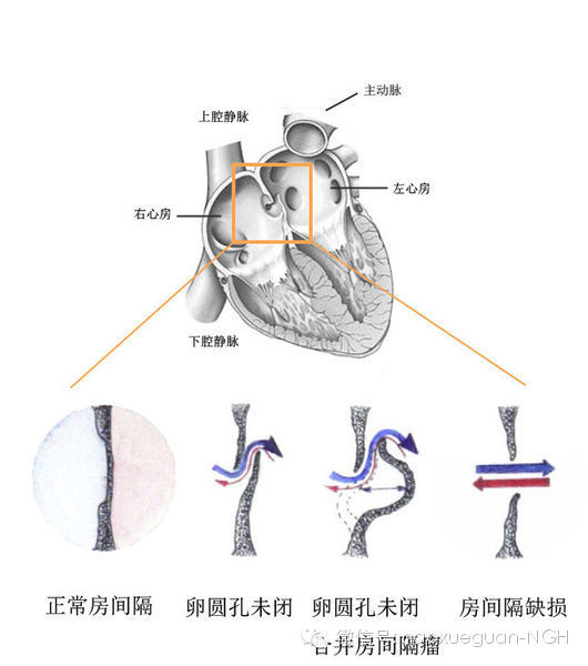 卵圆孔未闭与中风