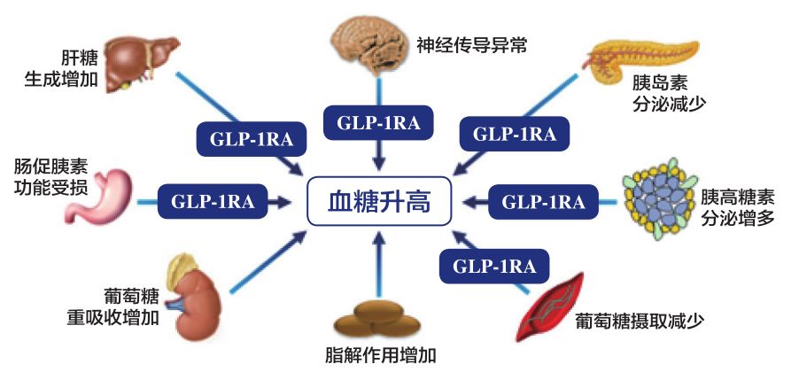 图1. glp-1ra可纠正糖尿病病理生理机制"八重奏"中的6种