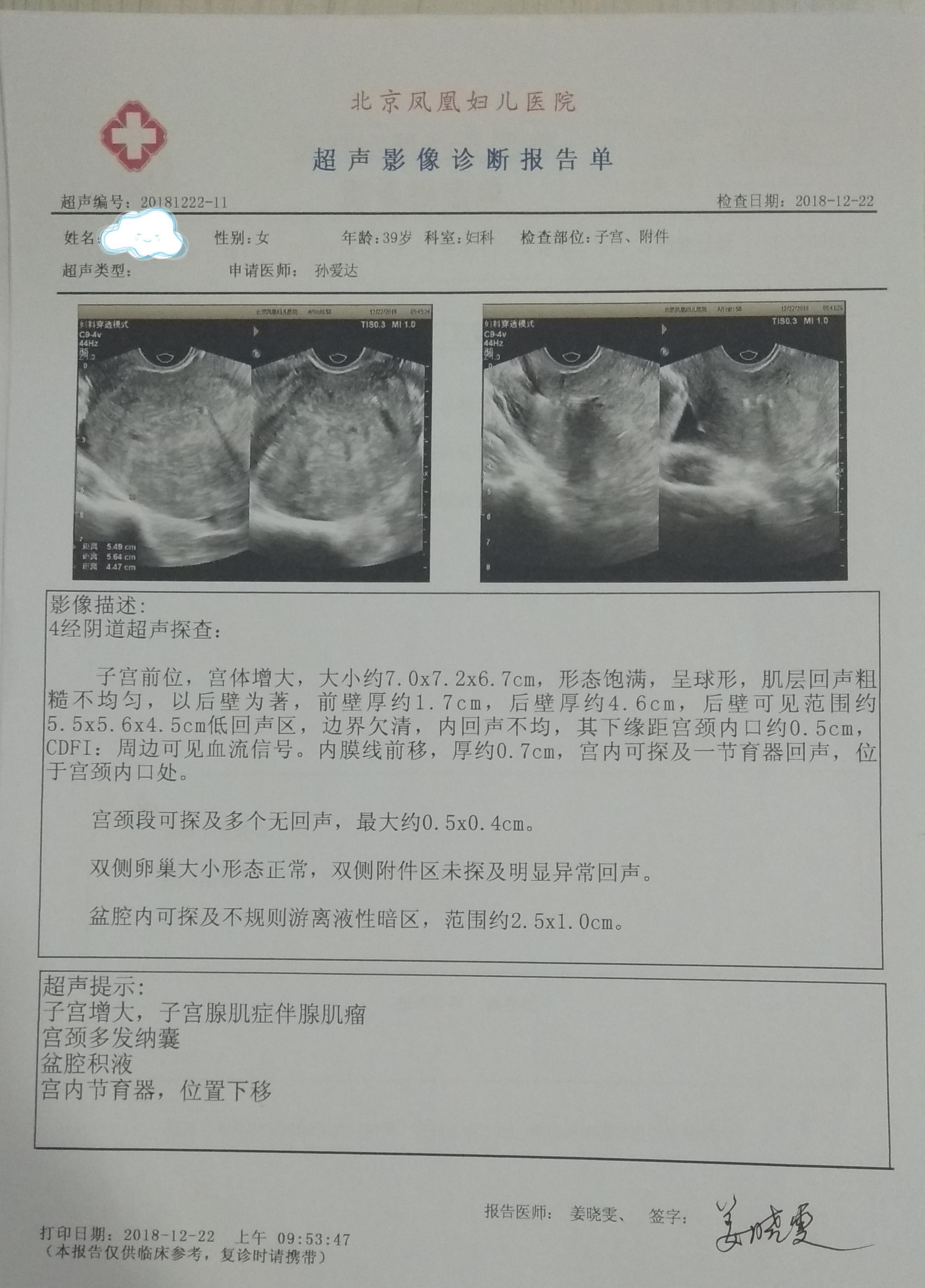 闭经治疗腺肌症,毕竟是"假"的!_子宫