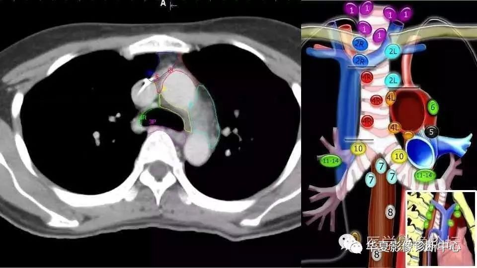 史上最全胸内淋巴结分区图解