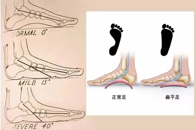 成语平足什么_平足是什么样子图片