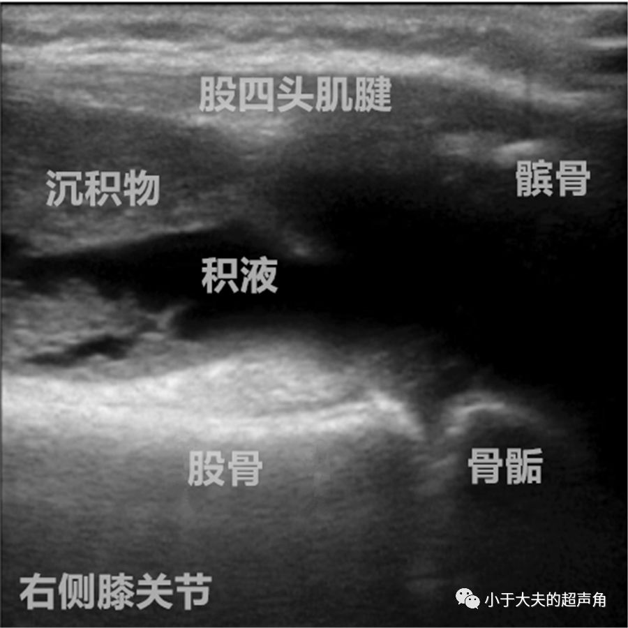 超声提示 双侧膝关节髌上囊积液,伴沉积物形成,建议风湿免疫相关