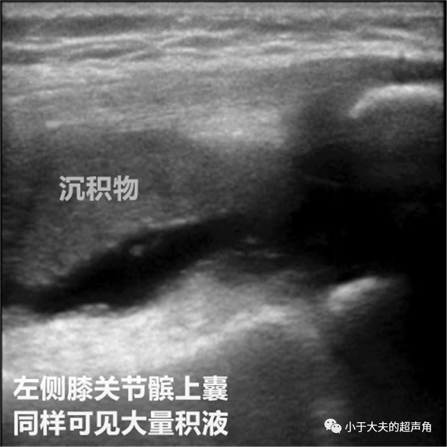 ②病程>6周遂行 超声检查,发现双侧膝关节髌上囊均可见液性区,左侧为