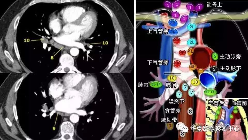 史上最全胸内淋巴结分区图解