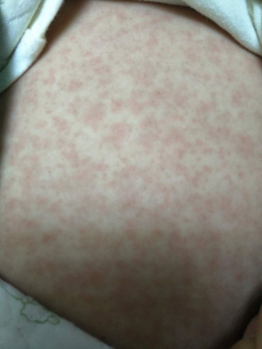 宝妈群里热议的幼儿急疹是啥?满身的疹子是正常发病过程吗?