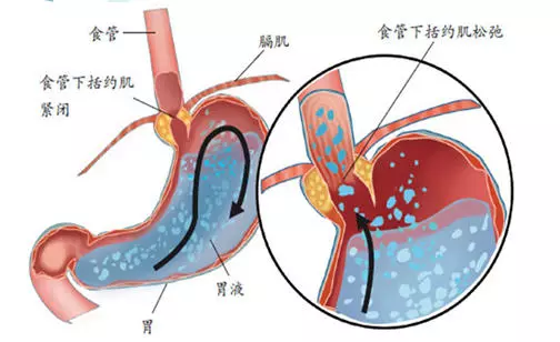 婴幼儿呛奶怎么办