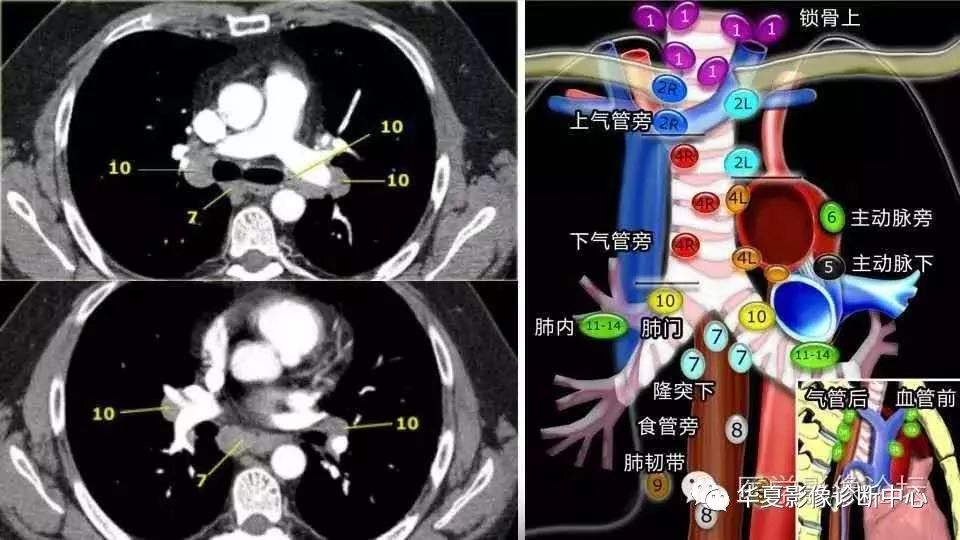 史上最全胸内淋巴结分区图解