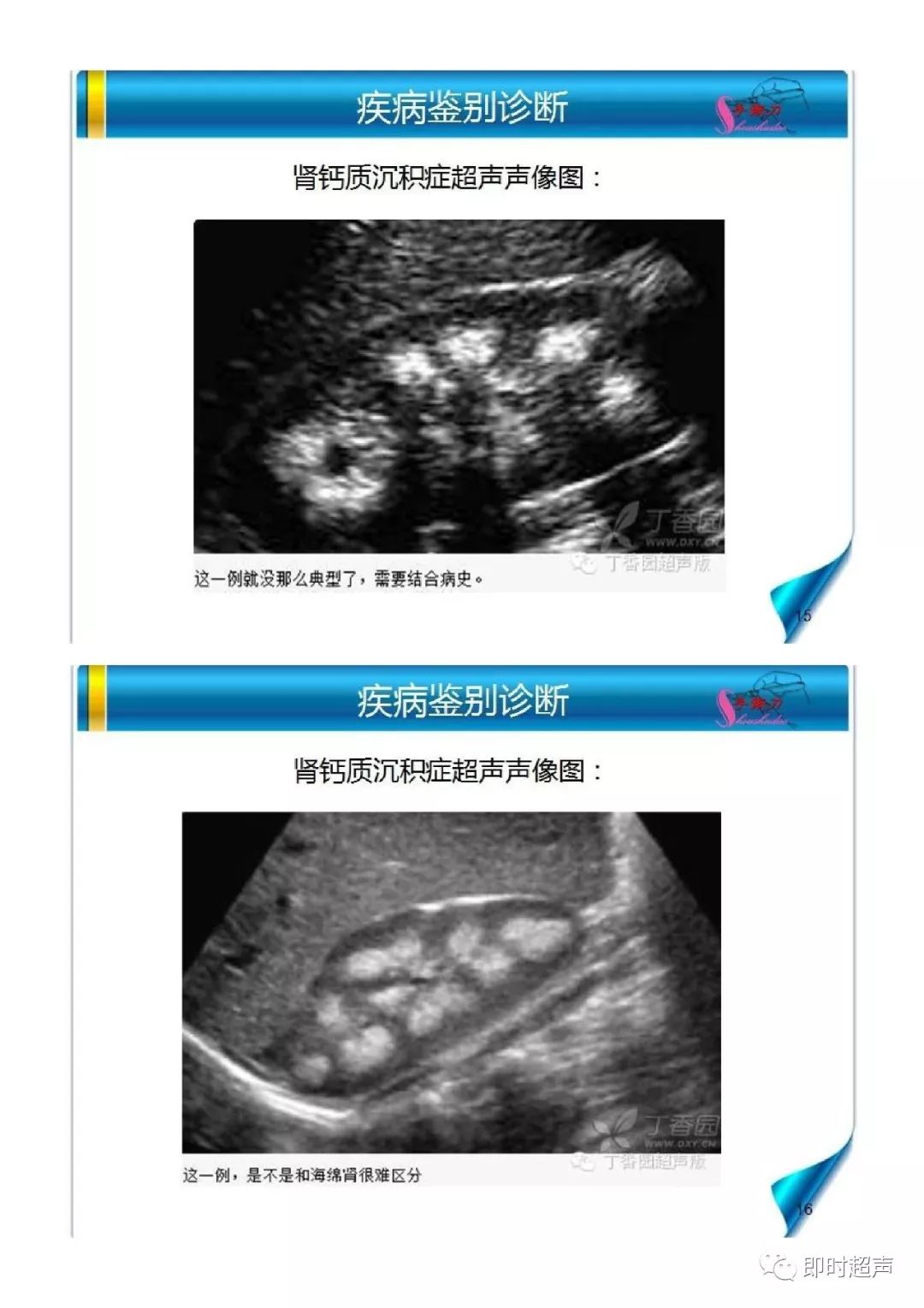 海绵肾超声诊断要点及鉴别诊断