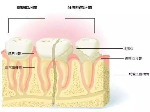 辣眼睛的牙周病发展过程