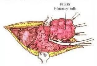 切除1515cm肺大泡两个小孔解决问题