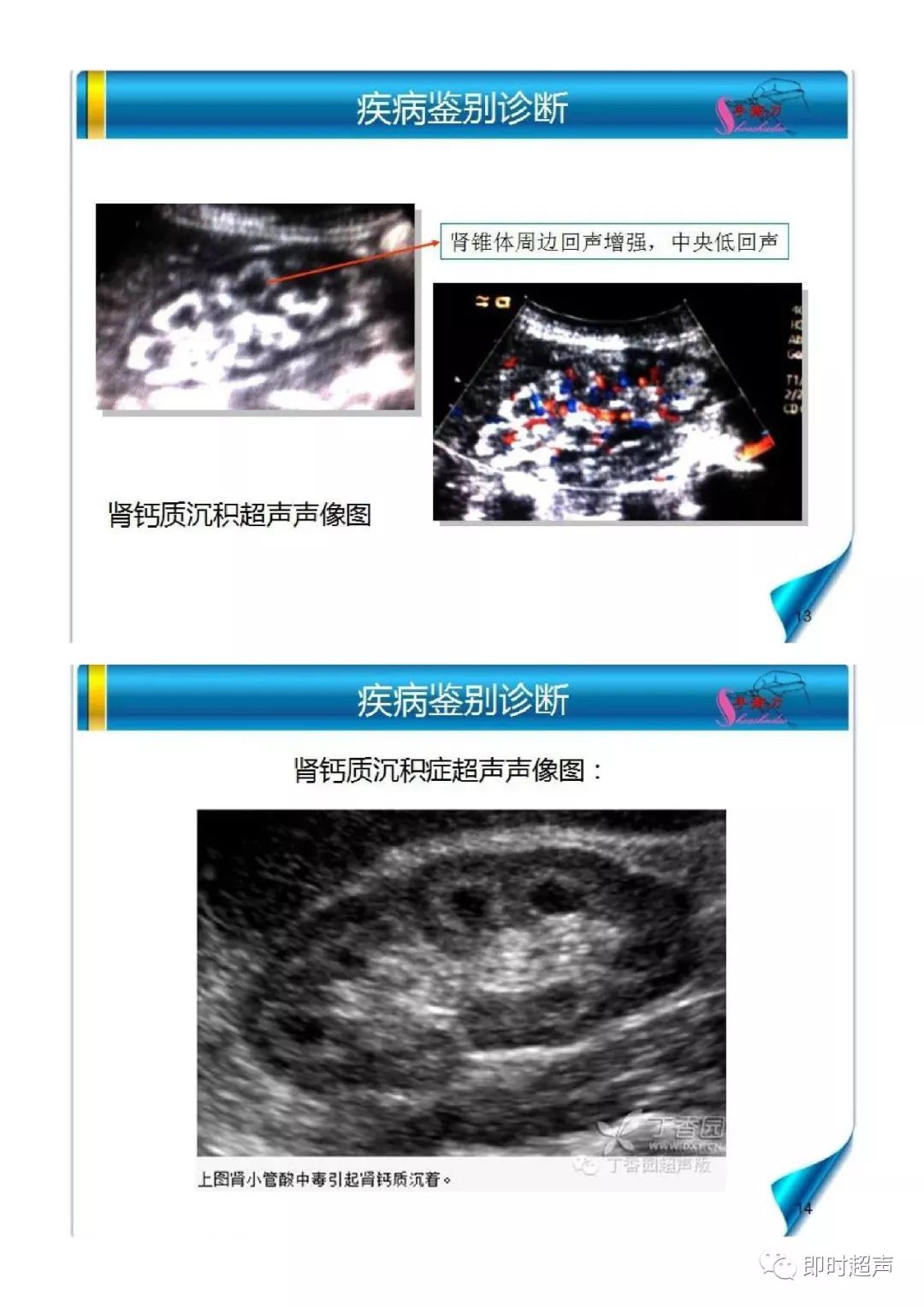 海绵肾超声诊断要点及鉴别诊断