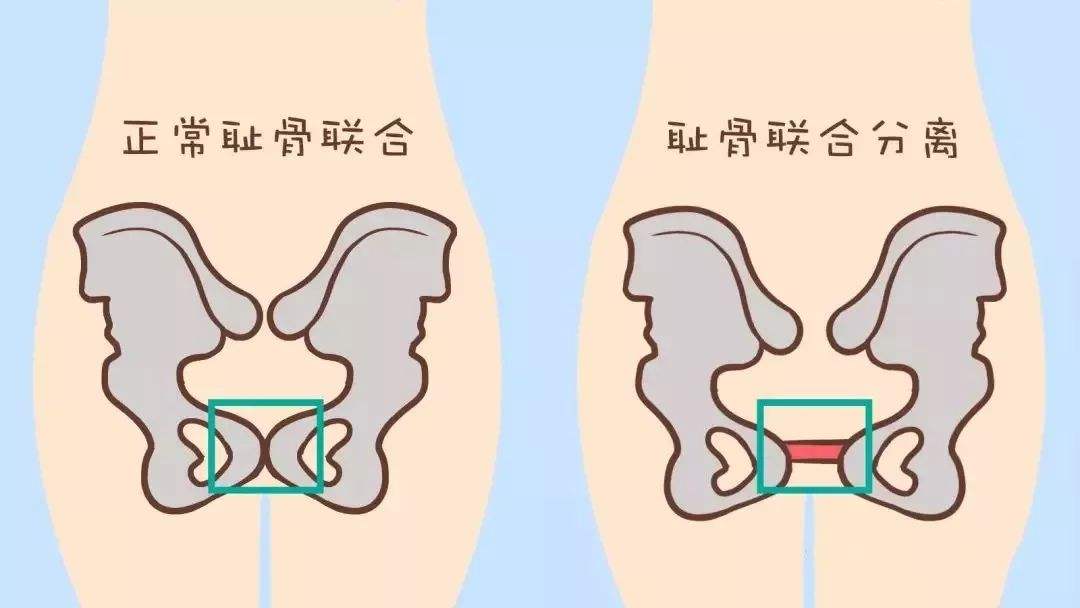 孕期出现这6种盆骨疼痛会让准妈妈身体有危害要注意了