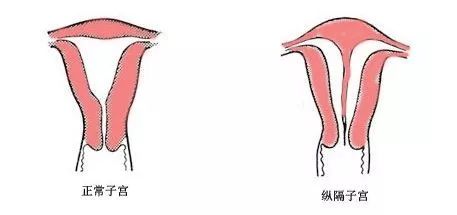 宫腔镜是个啥有啥用到底是检查还是手术