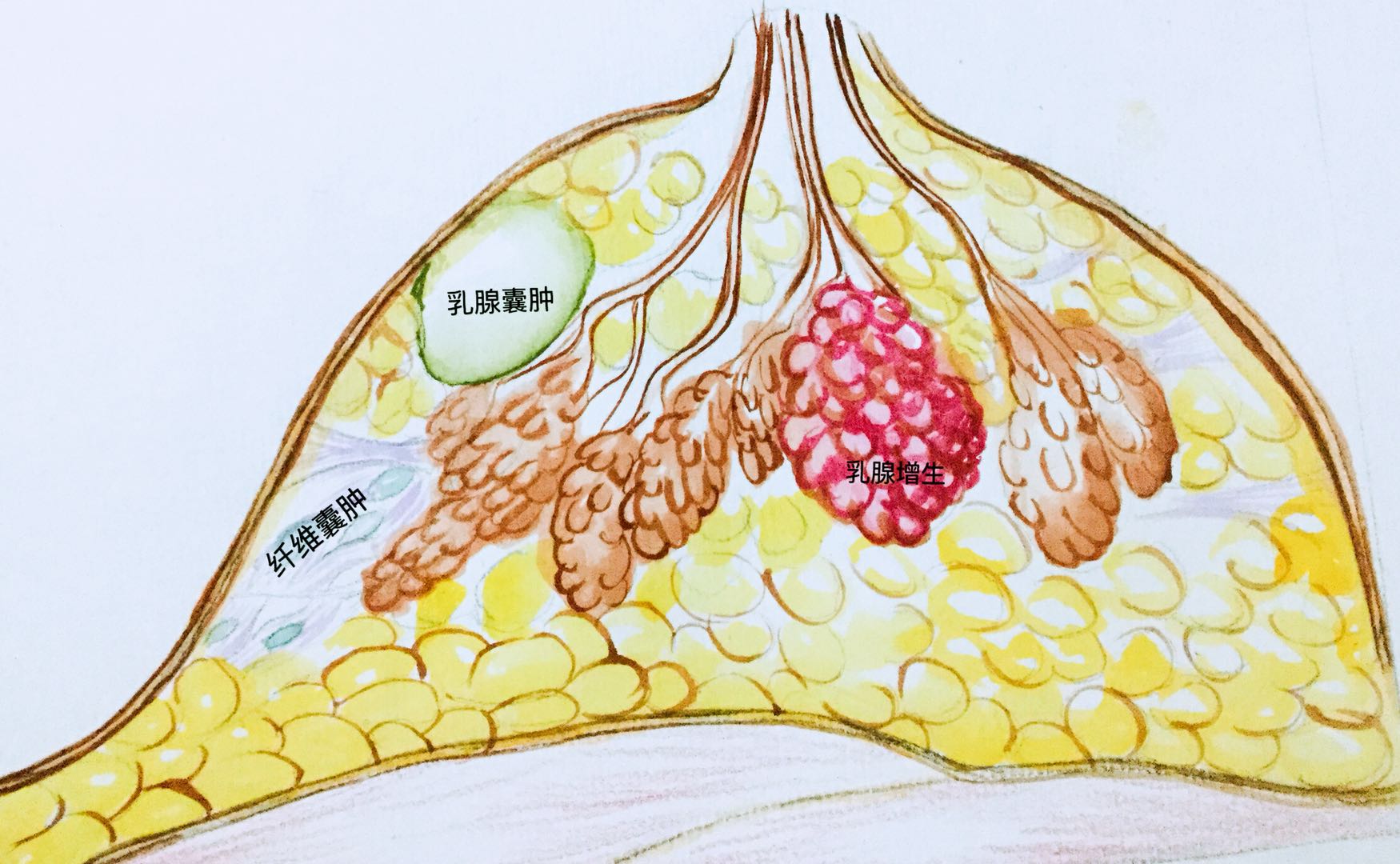 乳腺囊肿怎么形成的,需要手术吗