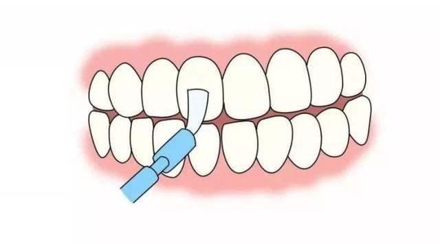 给牙齿涂 氟,小孩预防龋齿还有这一办法?