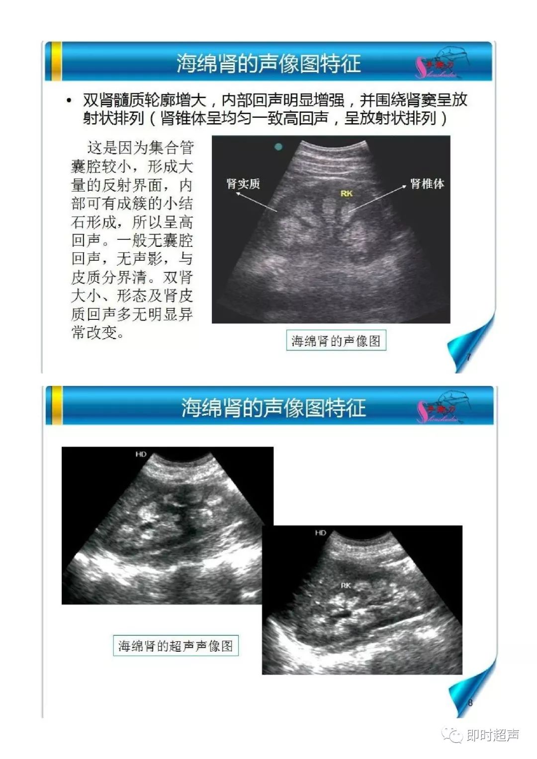 海绵肾超声诊断要点及鉴别诊断