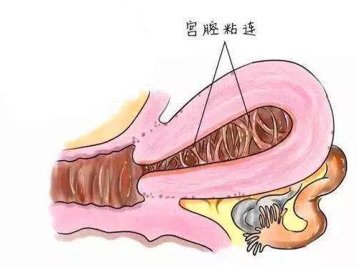 宫腔镜是个啥有啥用到底是检查还是手术