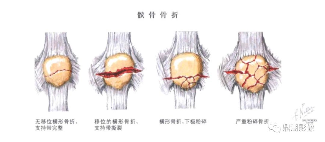 髌骨解剖及髌骨病变影像学表现