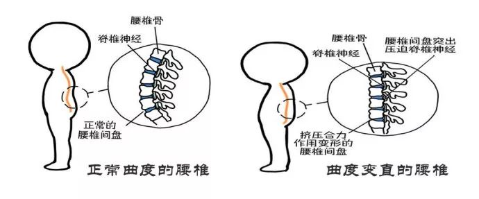 整条脊柱趋向变直