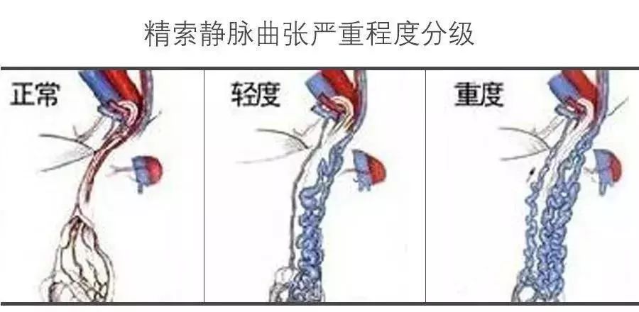 男人帮精索静脉曲张男性不育的隐形杀手