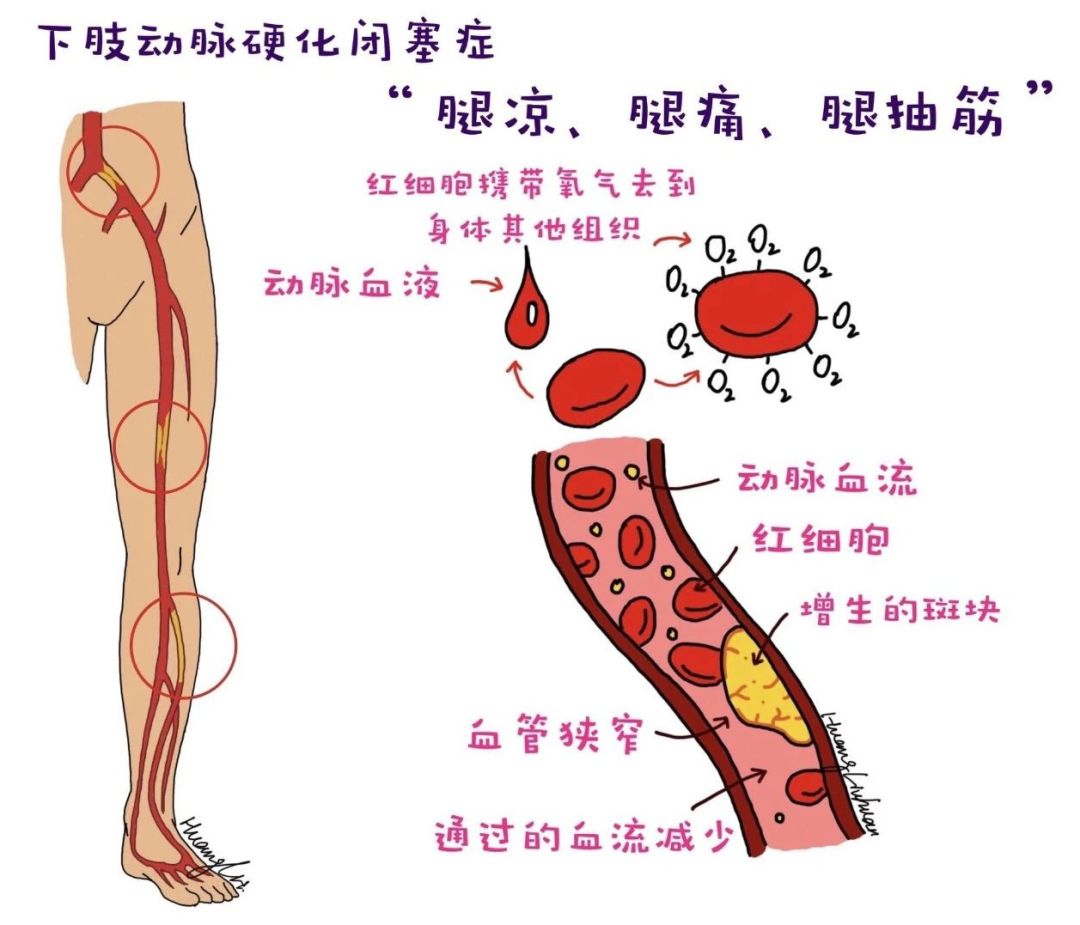 这期《健康直播间》带你一起走进 下肢动脉硬化闭塞症.