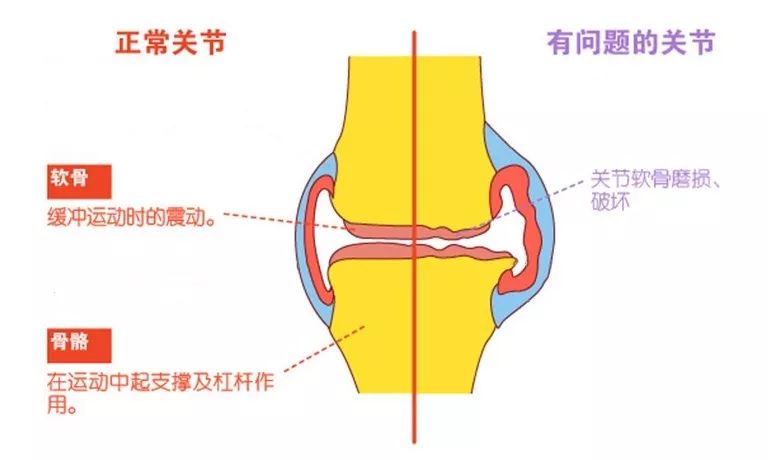 在膝关节交界处,关节骨头上有一层软骨,它会随年龄的增加而磨损.