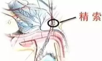 就是说,在100个精索静脉曲张当中疼痛发生率只有2-10%,可是,在这么多
