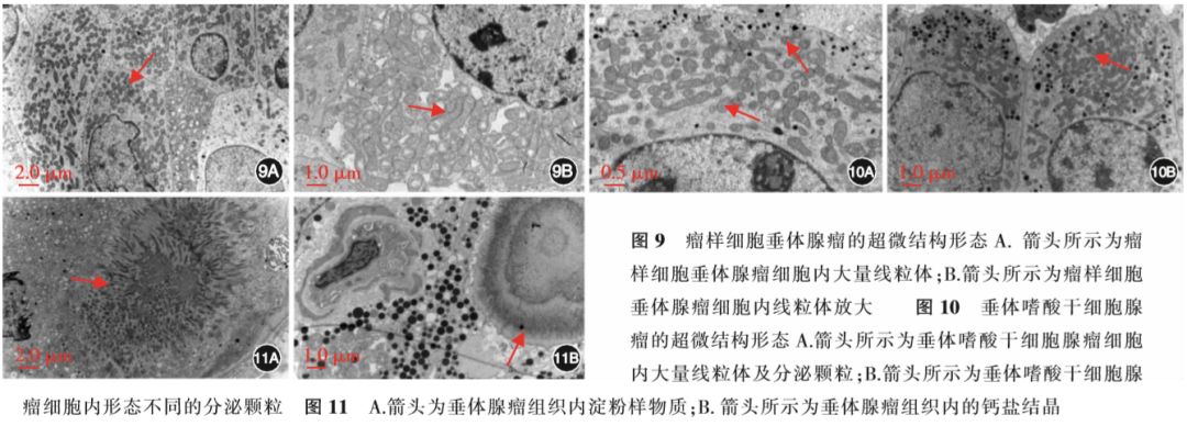 67垂体腺瘤超微病理分类在临床诊断中的应用中华神外2018年第十一期