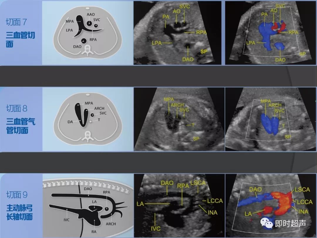胎儿心脏标准切面及扫查示例