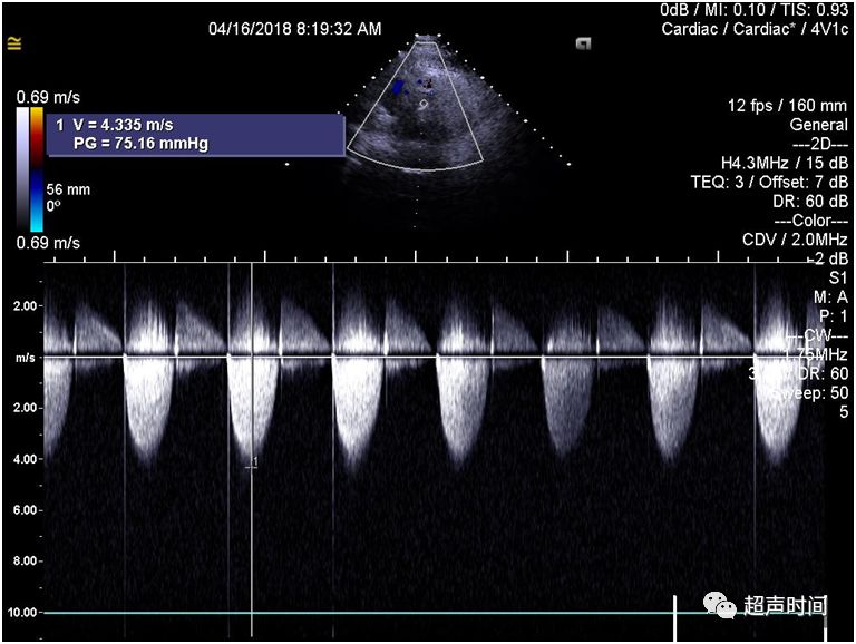 cdfi 可见经瓣口的高速湍流血流信号,频谱为收缩期高速湍流,湍流血流