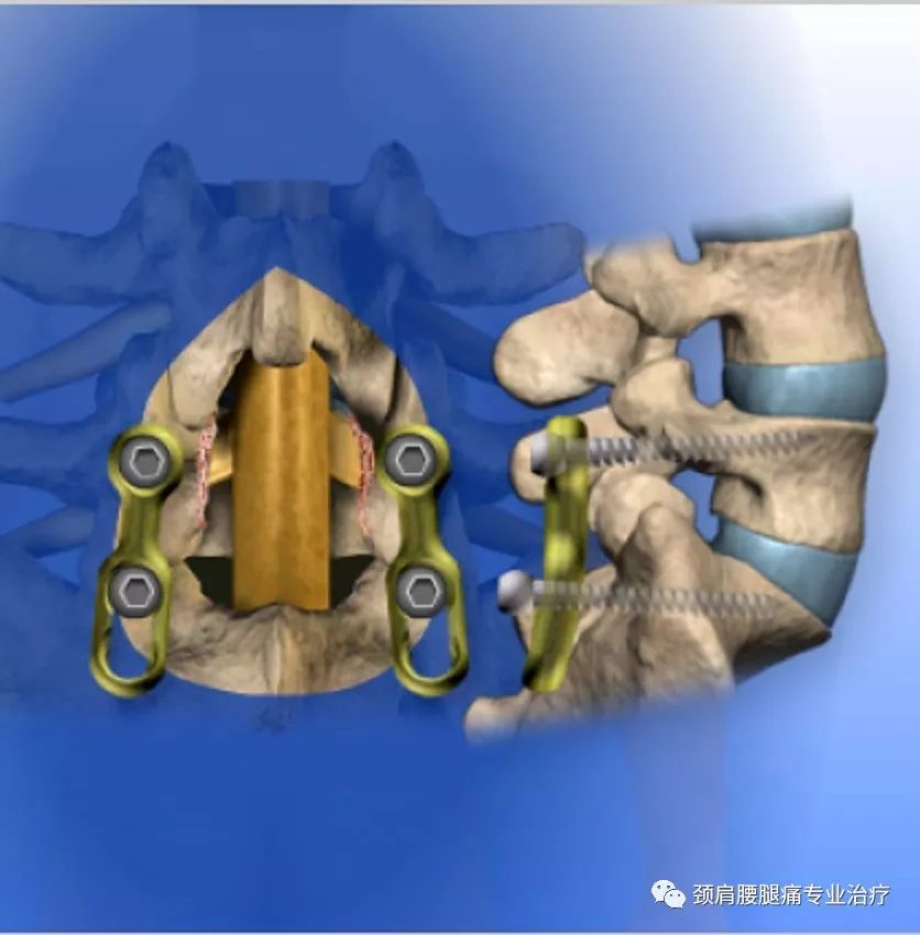 中英文字幕腰椎后路椎间融合术posteriorlumbarinterbodyfusionplif