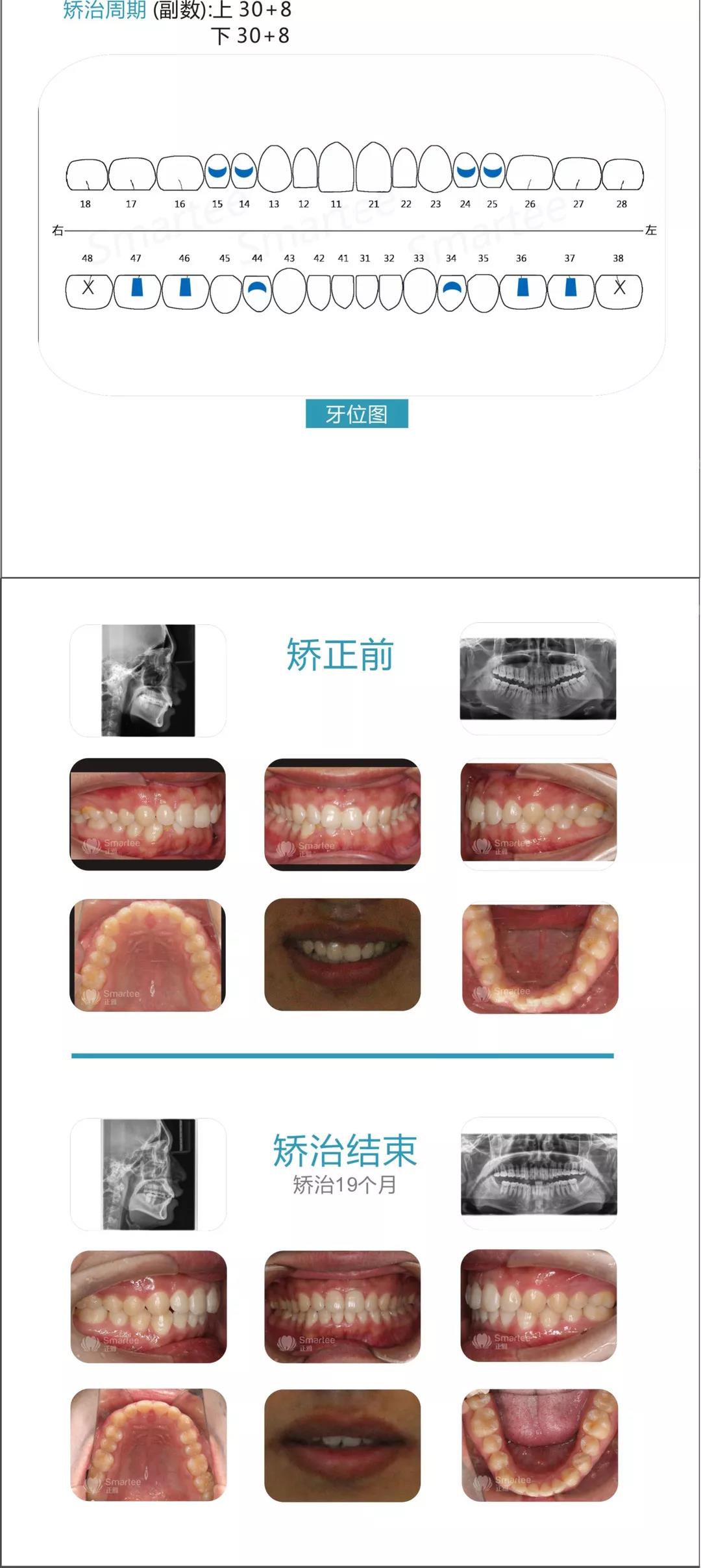 smartee正雅病例展示丨精选推磨牙向远中隐形矫治三大优秀病例