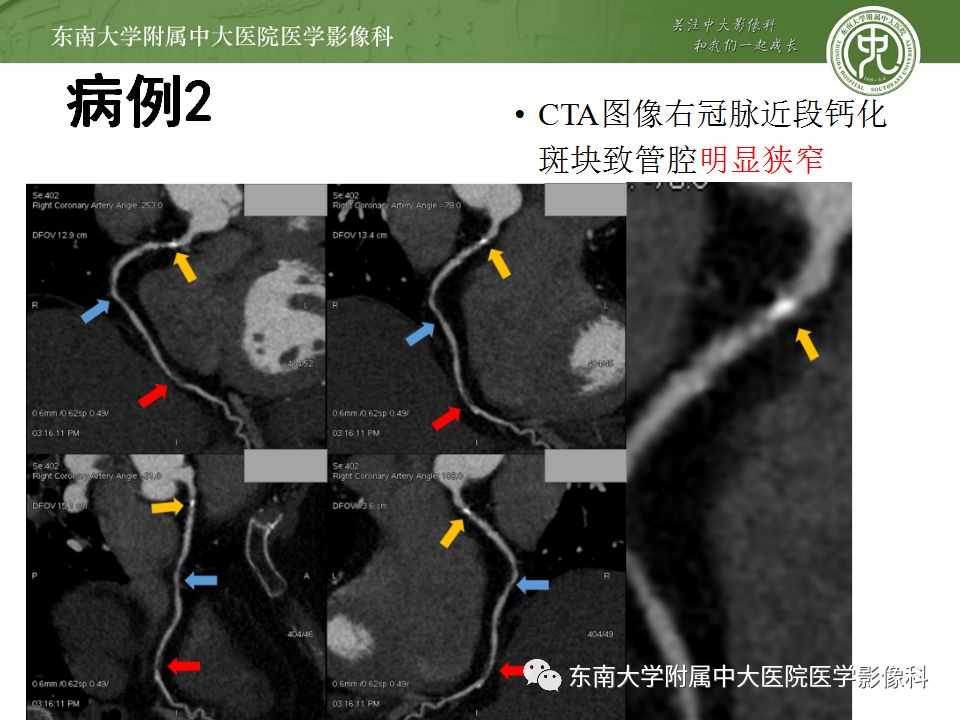 冠脉cta误判的常见因素