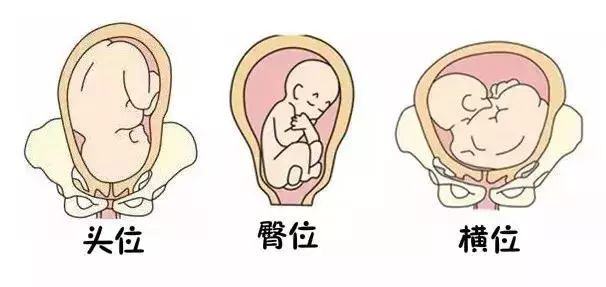 胎位一般分为头位,臀围,横位三种,如下图所示