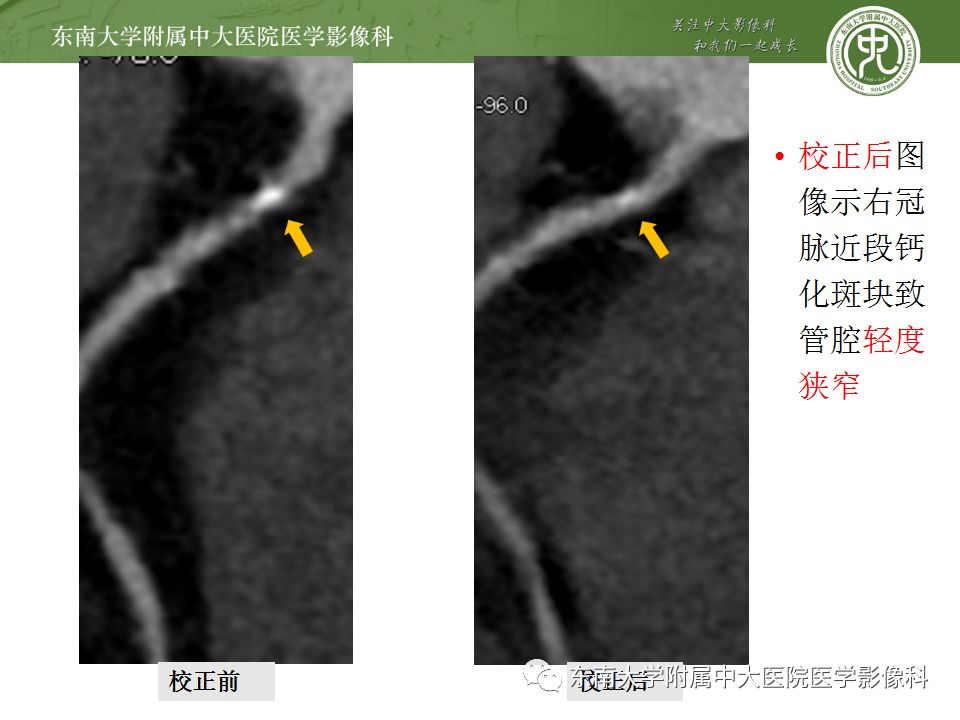 冠脉cta误判的常见因素